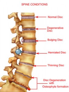 back pain disk
