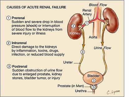 acute-renal-failure