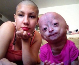progerija-mala-adalija-sa-mamom-foto-dejli-mejl-1361891656-274007