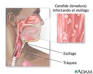 candida-infections