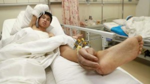 Man has severed hand attached to leg to keep it alive, Changsha, Hunan Province, China - 10 Dec 2013