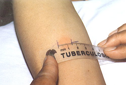 tuberkuloza tekst